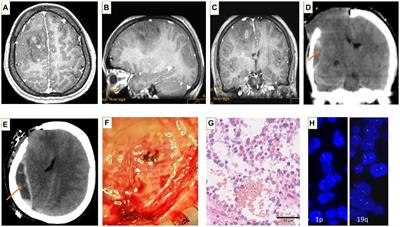 Case report: A rare case of cerebral herniation during glioma resection in a syphilis-positive patient